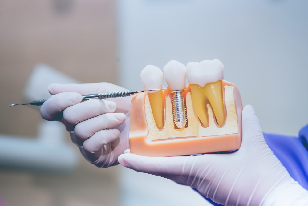 dental implants in wilbraham ma