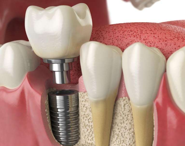 dental implant picture with post