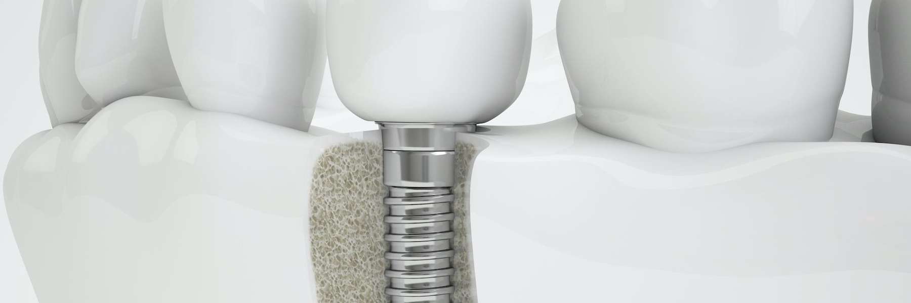 dental illustration | Wilbraham MA